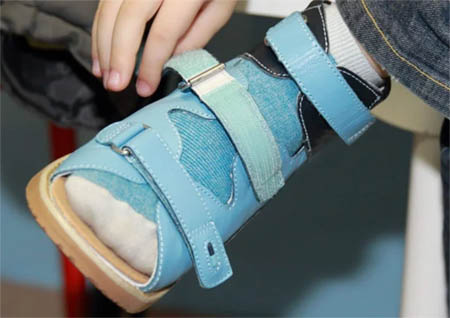 Примерка ортопедической обуви
